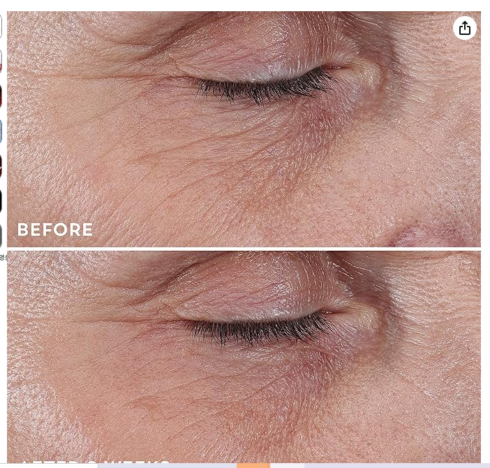 Before and After - fine lines around eye area